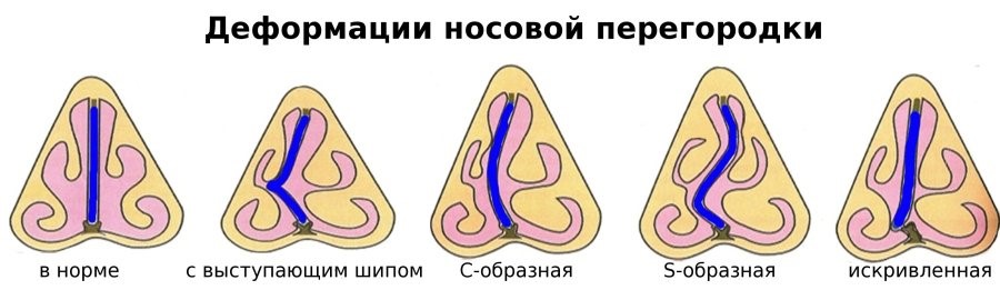 распространенные типы искривления носовой перегородки