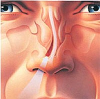 Методы лечения искривления носовой перегородки