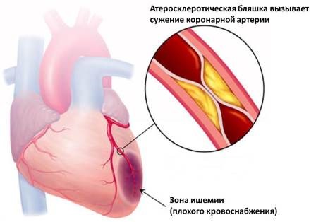 Лечение ишемической болезни сердца в Израиле