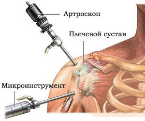 Артроскопия