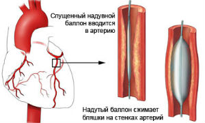 Балонная ангиопластика