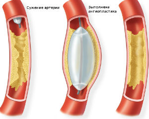 Балонная ангиопластика