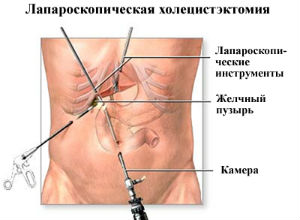 Лапароскопические операции на печени, поджелудочной железе, желчных путях