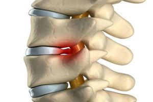 Лечение межпозвоночной грыжи в Израиле