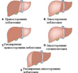 Операции на печени