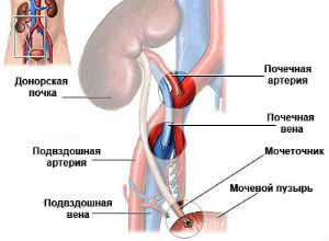 Пересадка почки