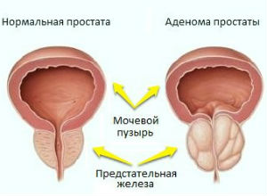 Простатэктомия (удаление предстательной железы)