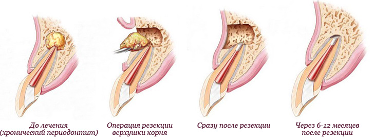 Резекция опухоли языка с немедленной микрохирургической реконструкцией