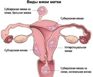 Лечение миомы матки