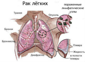 Удаление опухоли легкого