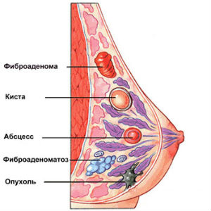 Удаление опухоли молочной железы (мастэктомия)