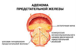 Удаление предстательной железы