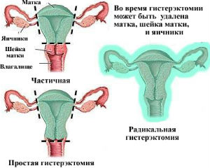 Удаление шейки матки