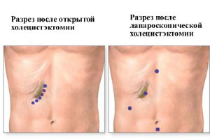 Снятие швов после лапароскопии желчного пузыря болит правый бок в районе талии сбоку у мужчин