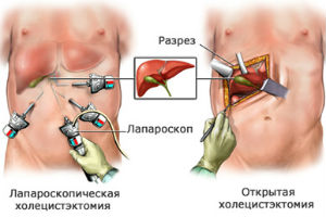 Удаление желчного пузыря лапароскопом