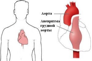 Аневризма грудной аорты