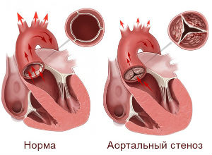 Аортальный стеноз