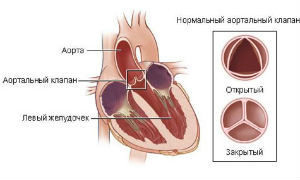 Аортальный стеноз