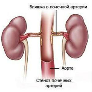 Атеросклеротический стеноз почечных артерий