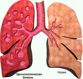 Бронхоэктатическая болезнь