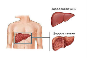 Цирроз печени