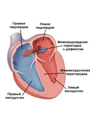 Дефект межпредсердной перегородки