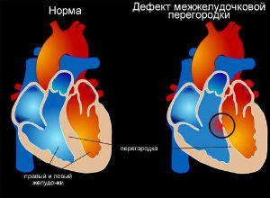 Дефект межжелудочковой перегородки