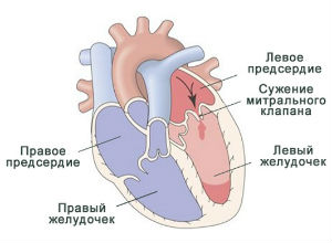 Стеноз митрального клапана