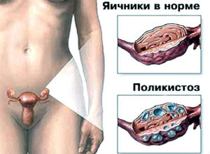 Синдром поликистозных яичников