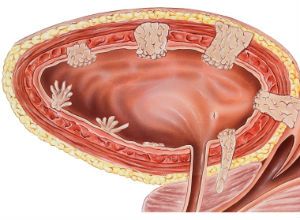 Рак мочевого пузыря
