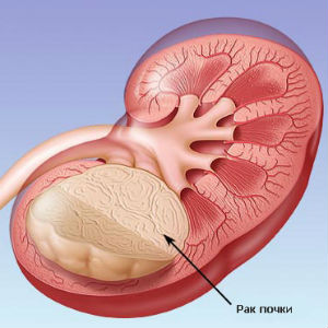 Рак почки
