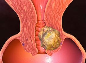 Рак шейки матки