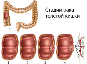 Рак толстой кишки