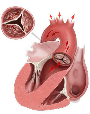 Стеноз митрального клапана