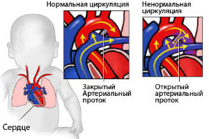 Врожденные пороки сердца